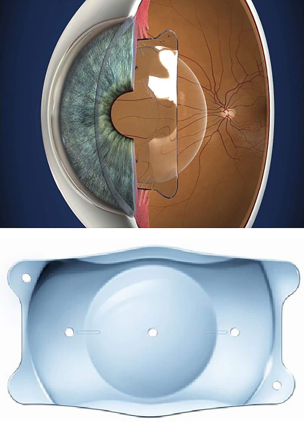 コンタクトレンズ 7